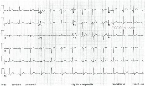 ecg 12 lead normal